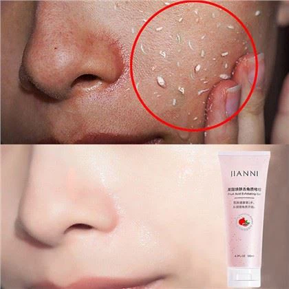Voćna kiselina za piling gel
